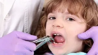 إيقاف النزيف بعد خلع الضرس