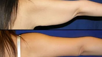 طريقة شد الترهلات