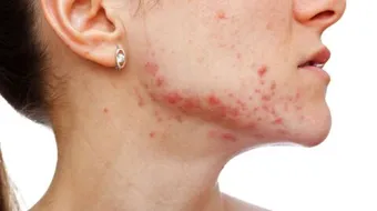 حب الشباب تحت الجلد