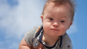 خلاصة عن مرض داون