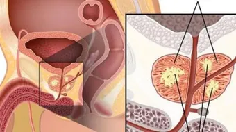 ملخص عن مرض البروستاتا