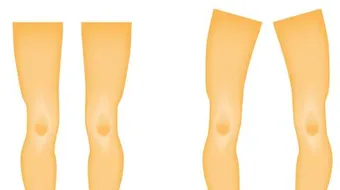 خلاصة عن مرض الكساح