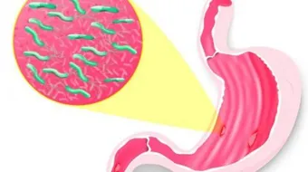 أعراض قرحة الاثني عشر وعلاجها