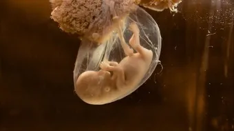 أعراض نقص ماء الجنين