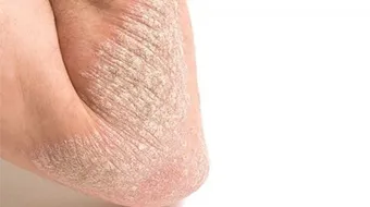 أعراض نقص فيتامين د على البشرة