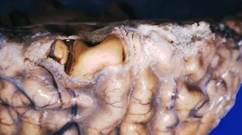 أعراض التهاب سحايا المخ