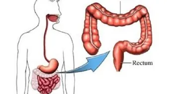 أعراض غازات القولون