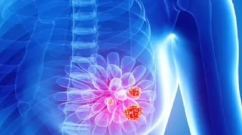 أعراض سرطان الثدي المبكرة