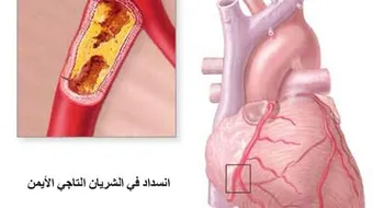 اعراض مرض القلب