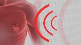 أعراض زيادة كهرباء القلب