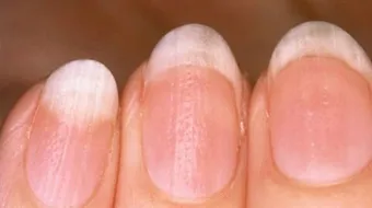 أعراض نقص الحديد