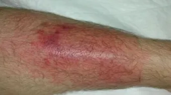 أعراض حمى البحر المتوسط