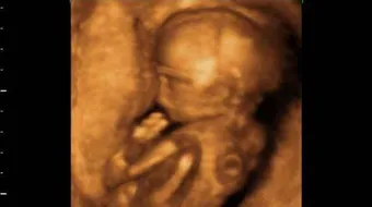 أعراض الحمل في الأسبوع الخامس