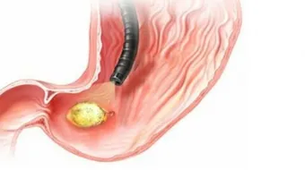 أعراض قرحة المعدة والاثني عشر