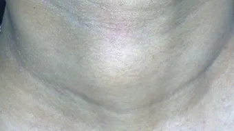 أعراض سرطان الغدة الدرقية