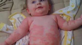 أعراض حساسية القمح