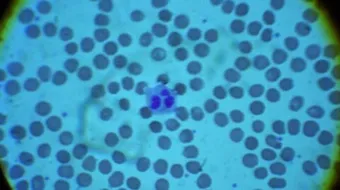 أعراض نقص كريات الدم البيضاء وعلاجها