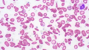 أعراض نقص كريات الدم البيضاء عند الرجال