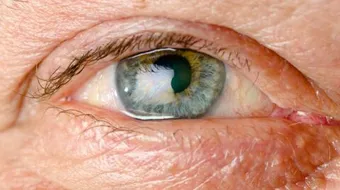 أعراض مرض ويلسون