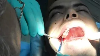 خلع ضرس العقل العلوي