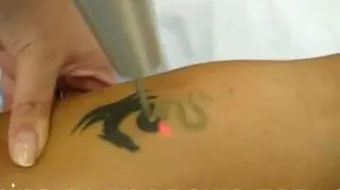 طريقة إزالة الوشم