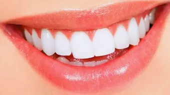 أضرار تلبيس الأسنان