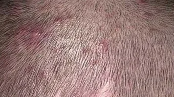 ظهور حبة في فروة الرأس