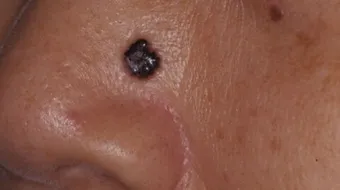 ظهور الشامات في الوجه