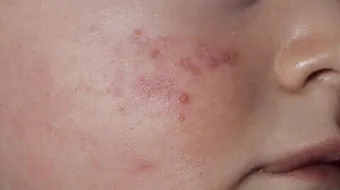 ظهور حبوب حمراء في الجسم عند الأطفال