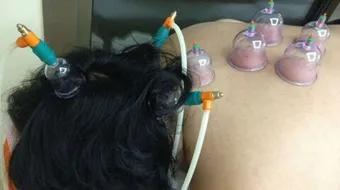 فوائد الحجامة في وسط الرأس