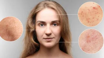 أفضل علاج لآثار حب الشباب