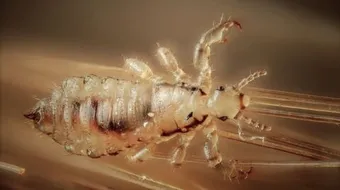 أفضل طريقة للتخلص من القمل وبيضه