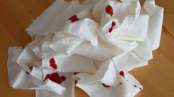 أفضل طريقة لوقف نزيف الأنف