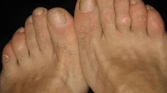 أفضل طريقة لعلاج مسمار القدم