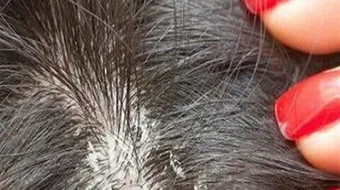 أفضل الطرق للتخلص من قشرة الشعر