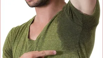 أسباب التعرق الكثير