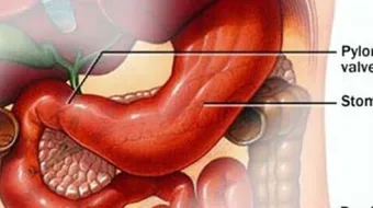 أسباب مرض جرثومة المعدة