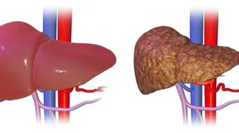 الفرق بين تشمع الكبد وتليف الكبد
