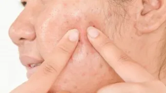 أسهل طريقة للتخلص من حب الشباب وآثاره