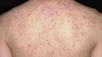 آثار حب الشباب بالظهر