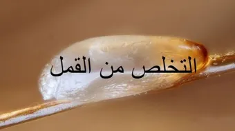 أسرع طريقة للقضاء على القمل وبيضه
