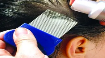 أسرع طريقة للتخلص من القمل