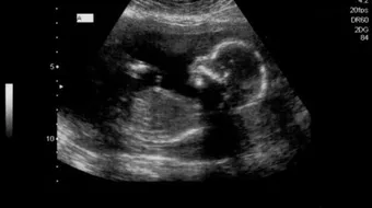 الجنين في الأسبوع السابع عشر