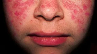 نسبة حدوث الذئبة الحمراء