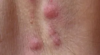 عدد الغدد الليمفاوية تحت الإبط