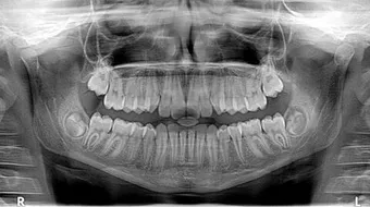 عدد الضروس والأسنان
