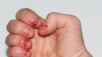 مشكلة قضم الأظافر لدى الأطفال