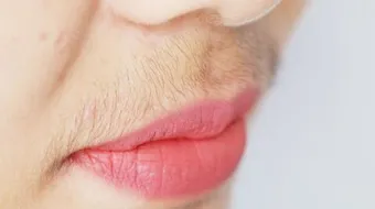 سبب ظهور الشعر في الذقن لدى النساء