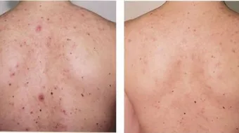 سبب ظهور حبوب في الجسم