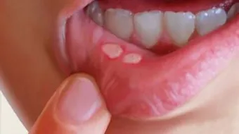 سبب ظهور حبوب داخل الفم